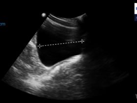 Jak obliczyć objętość pęcherza moczowego u dzieci i porównać uzyskany wynik z normą dla wieku pacjenta? | Portal wymiany wiedzy o ultrasonografii - Eduson