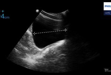 Jak obliczyć objętość pęcherza moczowego u dzieci i porównać uzyskany wynik z normą dla wieku pacjenta? | Portal wymiany wiedzy o ultrasonografii - Eduson