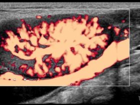 Ocena unaczynienia węzłów chłonnych. | Portal wymiany wiedzy o ultrasonografii - Eduson
