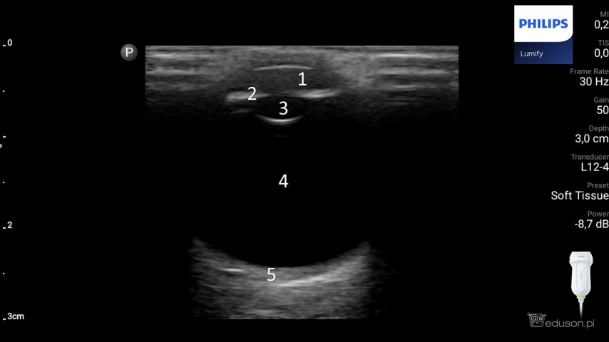 Anatomia ultrasonograficzna gałki ocznej. Głowica liniowa. Philips Lumify.