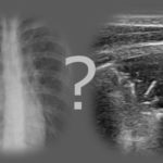 Czy można rozpoznać zapalenie płuc, jeśli nie widać zmian w badaniu rtg, a są obecne zmiany w badaniu usg? | Portal wymiany wiedzy o ultrasonografii - Eduson