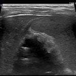 Chłopiec z zapaleniem pęcherzyka żółciowego - czy wołać chirurga? - Portal wymiany wiedzy o ultrasonografii - Eduson