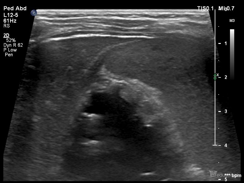 Chłopiec z zapaleniem pęcherzyka żółciowego - czy wołać chirurga? | Portal wymiany wiedzy o ultrasonografii - Eduson
