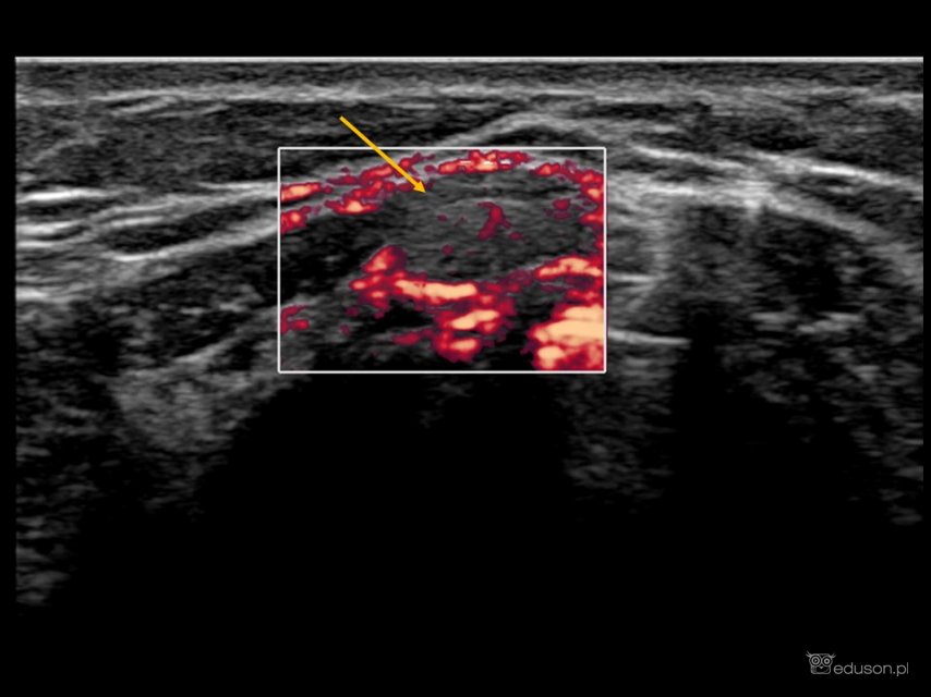 Czy zaznaczona struktura uwidoczniona podczas usg szyi wymaga dalszej diagnostyki? - Portal wymiany wiedzy o ultrasonografii - Eduson
