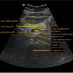 jak wygląda prawidłowy obraz USG trzustki | Portal wymiany wiedzy o ultrasonografii - Eduson