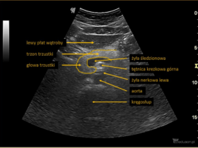 trzustka - Portal wymiany wiedzy o ultrasonografii - Eduson
