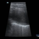 Przezklatkowe badanie usg płuc u kobiety w ciąży - Portal wymiany wiedzy o ultrasonografii - Eduson