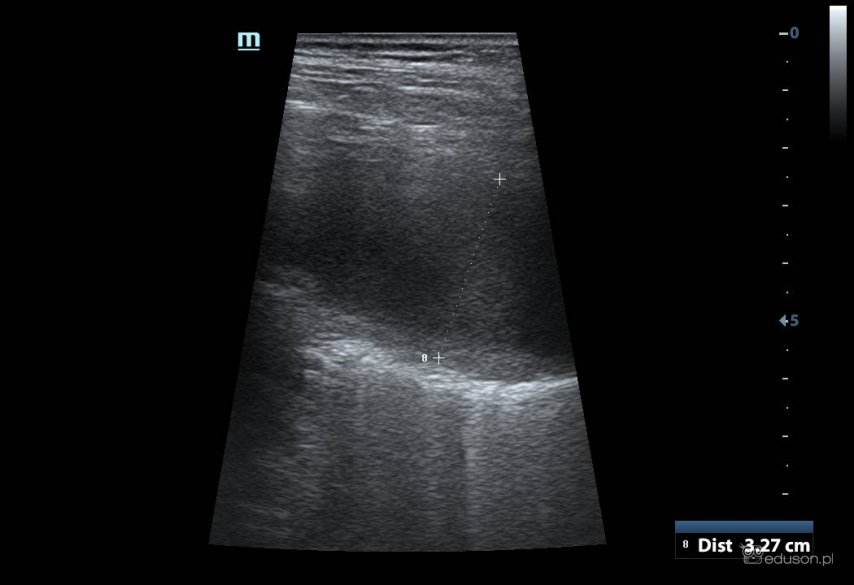 Przezklatkowe badanie usg płuc u kobiety w ciąży | Portal wymiany wiedzy o ultrasonografii - Eduson