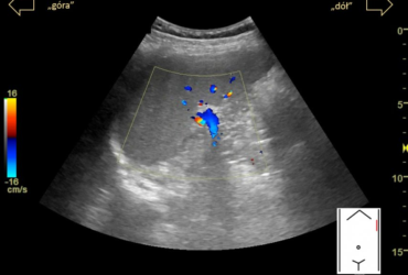 jak wygląda prawidłowy obraz USG śledziony | Portal wymiany wiedzy o ultrasonografii - Eduson
