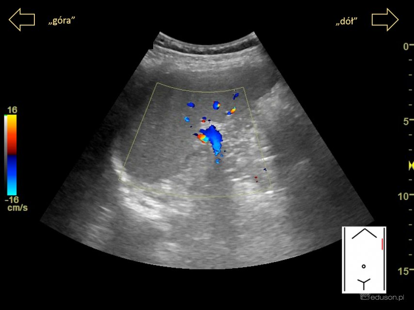 jak wygląda prawidłowy obraz USG śledziony | Portal wymiany wiedzy o ultrasonografii - Eduson