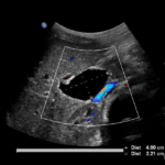 Torbiel we wnęce wątroby u noworodka | Portal wymiany wiedzy o ultrasonografii - Eduson