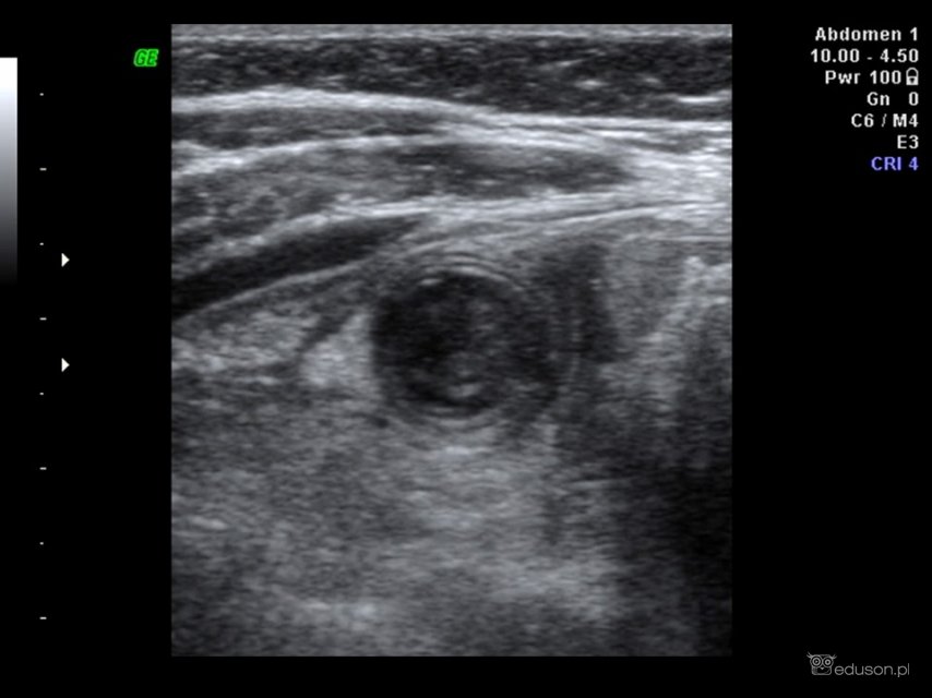Zapalenie wyrostka robaczkowego - galeria obrazów ultrasonograficznych