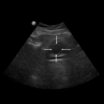 Ureterocele - Portal wymiany wiedzy o ultrasonografii - Eduson