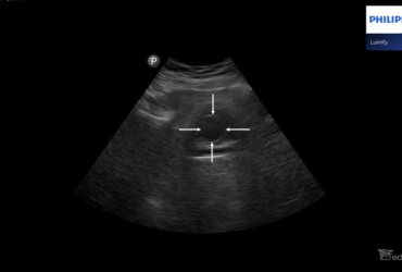 Ureterocele | Portal wymiany wiedzy o ultrasonografii - Eduson