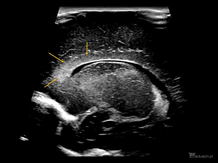 Podwyższona echogeniczność istoty białej okołokomorowa (żółte strzałki) u noworodka z infekcją CMV.