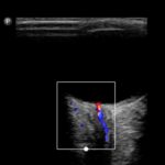 USG nerwu wzrokowego w podejrzeniu podwyższonego ciśnienia śródczaszkowego - Portal wymiany wiedzy o ultrasonografii - Eduson
