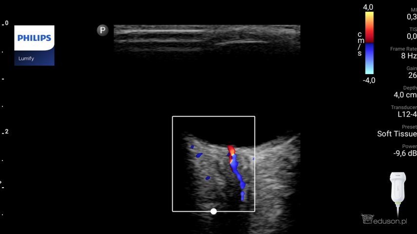 USG nerwu wzrokowego w podejrzeniu podwyższonego ciśnienia śródczaszkowego | Portal wymiany wiedzy o ultrasonografii - Eduson