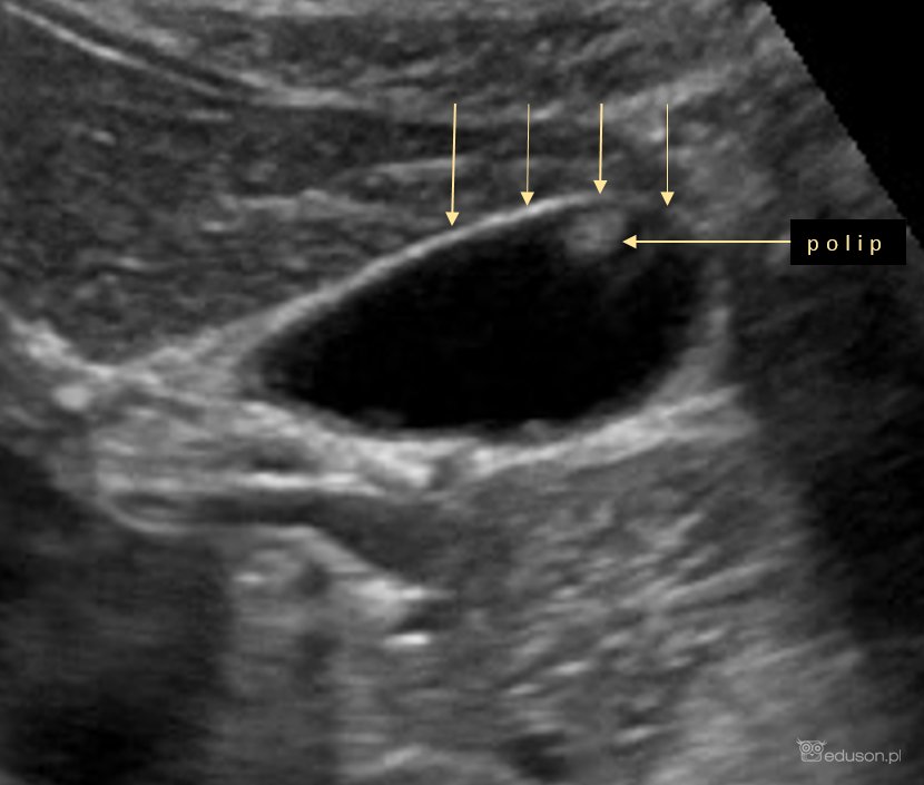 Polipy pęcherzyka żółciowego - Portal wymiany wiedzy o ultrasonografii - Eduson