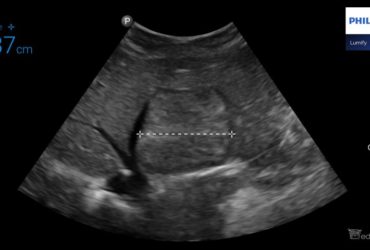 Ogniskowy rozrost guzkowy (ang. FNH, focal nodular hyperplasia) u dzieci - Portal wymiany wiedzy o ultrasonografii - Eduson