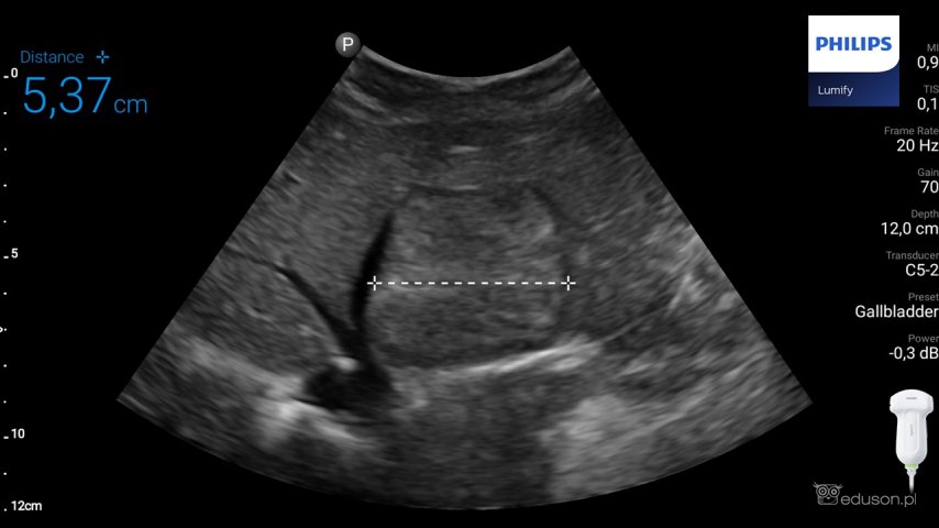 Ogniskowy rozrost guzkowy (ang. FNH, focal nodular hyperplasia) u dzieci | Portal wymiany wiedzy o ultrasonografii - Eduson