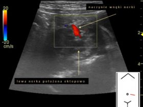 Trudności w uwidocznieniu jednej z nerek | Portal wymiany wiedzy o ultrasonografii - Eduson