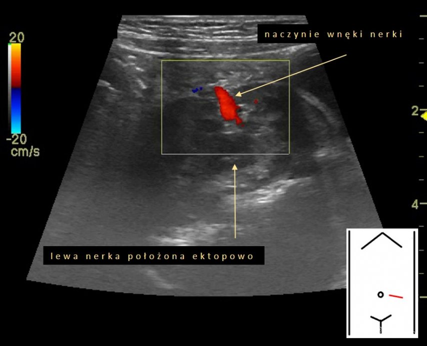 Trudności w uwidocznieniu jednej z nerek | Portal wymiany wiedzy o ultrasonografii - Eduson