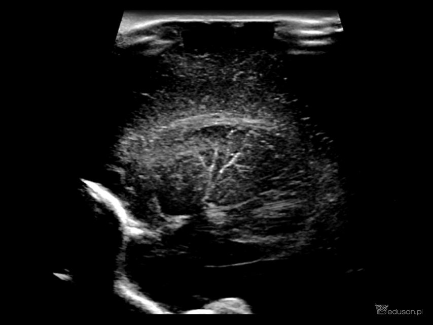 Waskulopatia prążkowiowo-wzgórzowa LSV w noworodka z infekcją CMV.