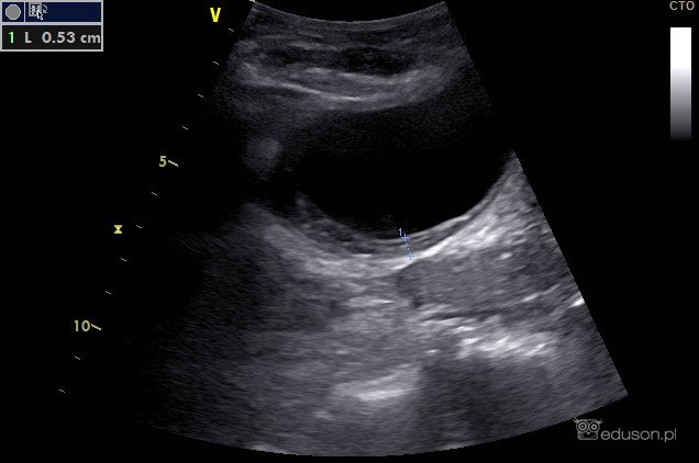 Bezkamicze zgorzelinowe zapalenie pęcherzyka żółciowego | Portal wymiany wiedzy o ultrasonografii - Eduson