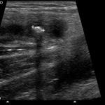 Zapalenie wyrostka robaczkowego - galeria obrazów ultrasonograficznych - część 1. - Portal wymiany wiedzy o ultrasonografii - Eduson
