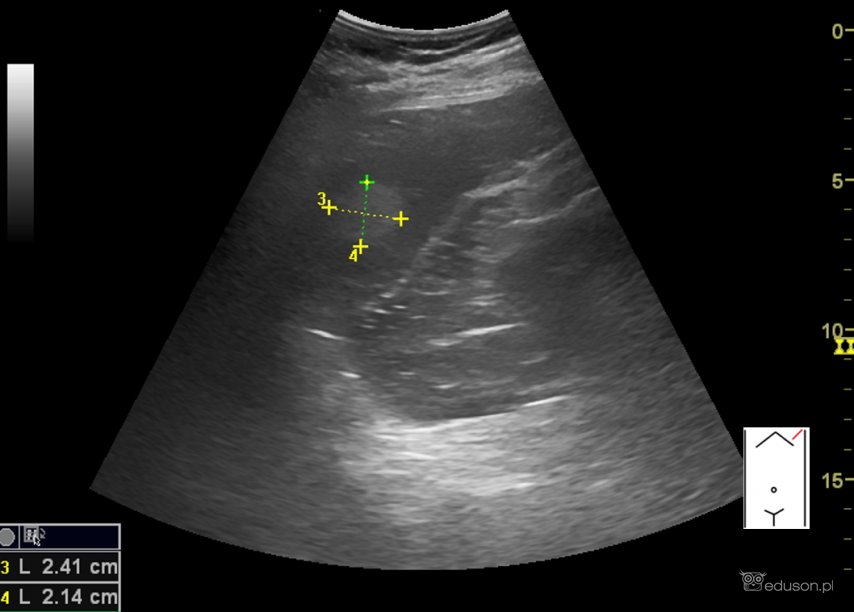 Naczyniak śledziony - Portal wymiany wiedzy o ultrasonografii - Eduson