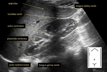 jak wygląda prawidłowy obraz USG nerki | Portal wymiany wiedzy o ultrasonografii - Eduson