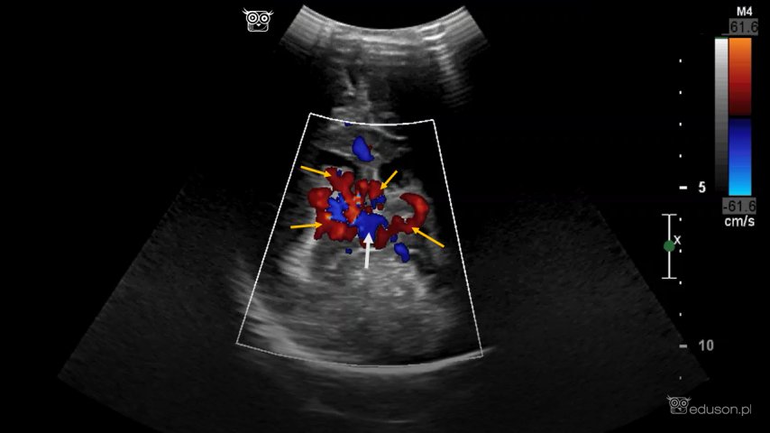 Malformacja żyły Galena | Portal wymiany wiedzy o ultrasonografii - Eduson