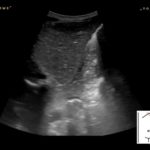 Ultrasonograficzna ocena połączenia żołądkowo-przełykowego u dzieci | Portal wymiany wiedzy o ultrasonografii - Eduson