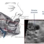 Dziewczynka z guzem policzka - Portal wymiany wiedzy o ultrasonografii - Eduson