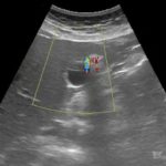 adenomiomatoza pęcherzyka żółciowego | Portal wymiany wiedzy o ultrasonografii - Eduson