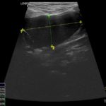 Torbiel boczna szyi - Portal wymiany wiedzy o ultrasonografii - Eduson