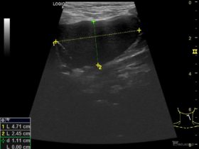 Torbiel boczna szyi - Portal wymiany wiedzy o ultrasonografii - Eduson