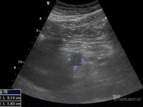 Guz trzustki - technika badania naprawdę ma znaczenie... | Portal wymiany wiedzy o ultrasonografii - Eduson