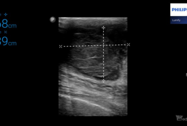 42-letni mężczyzna z guzem prawego sutka | Portal wymiany wiedzy o ultrasonografii - Eduson