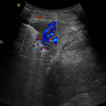 Co kryje się w przezklatkowym badaniu usg płuc u 40-letniego mężczyzny ze zmianami skórnymi klatki piersiowej? | Portal wymiany wiedzy o ultrasonografii - Eduson