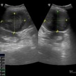 Guz śledziony | Portal wymiany wiedzy o ultrasonografii - Eduson