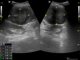 Guz śledziony | Portal wymiany wiedzy o ultrasonografii - Eduson