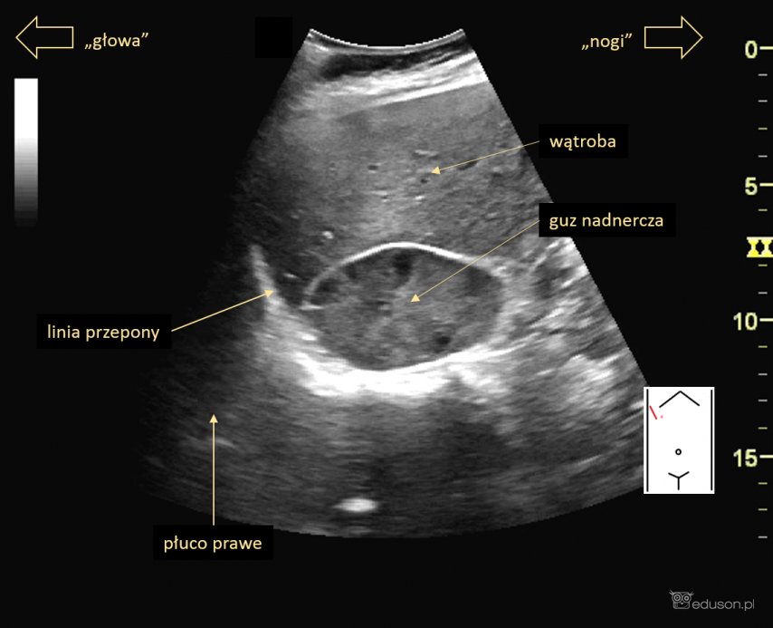 Guz prawego nadnercza - Portal wymiany wiedzy o ultrasonografii - Eduson