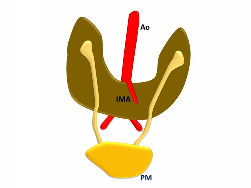 Schemat przedstawiający zatrzymanie procesu wstępowania nerki podkowiastej w czasie rozwoju embrionalnego. Ao - aorta. IMA - tętnica krezkowa dolna. PM - pęcherz moczowy. Na schemacie widoczne jest także nieprawidłowe położenie miedniczek nerkowych, wynikające z niepełnej rotacji. Miedniczki nerkowe leżą brzusznie i wyżej.