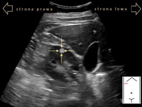Naczyniakomięśniakotłuszczak - angiomyolipoma (AML) | Portal wymiany wiedzy o ultrasonografii - Eduson