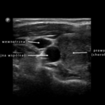Pomiar grubości kompleksu błony środkowej i wewnętrznej tętnicy szyjnej (intima-media complex thickness) | Portal wymiany wiedzy o ultrasonografii - Eduson