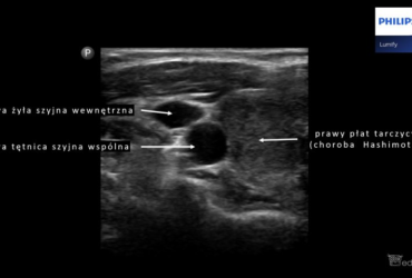 Pomiar grubości kompleksu błony środkowej i wewnętrznej tętnicy szyjnej (intima-media complex thickness) - Portal wymiany wiedzy o ultrasonografii - Eduson