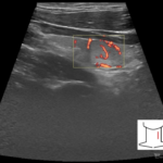 FLUS w BACC tarczycy, czyli jak postąpić w przypadku III kategorii wg klasyfikacji Bethesda | Portal wymiany wiedzy o ultrasonografii - Eduson