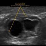 Torbiel w jamie brzusznej u 3-miesięcznego dziecka - Portal wymiany wiedzy o ultrasonografii - Eduson