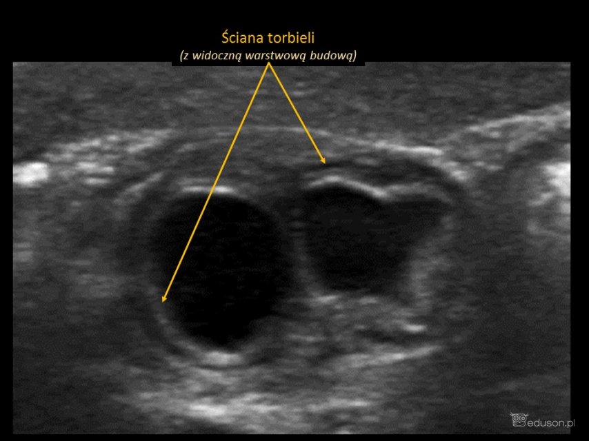 Torbiel w jamie brzusznej u 3-miesięcznego dziecka - Portal wymiany wiedzy o ultrasonografii - Eduson